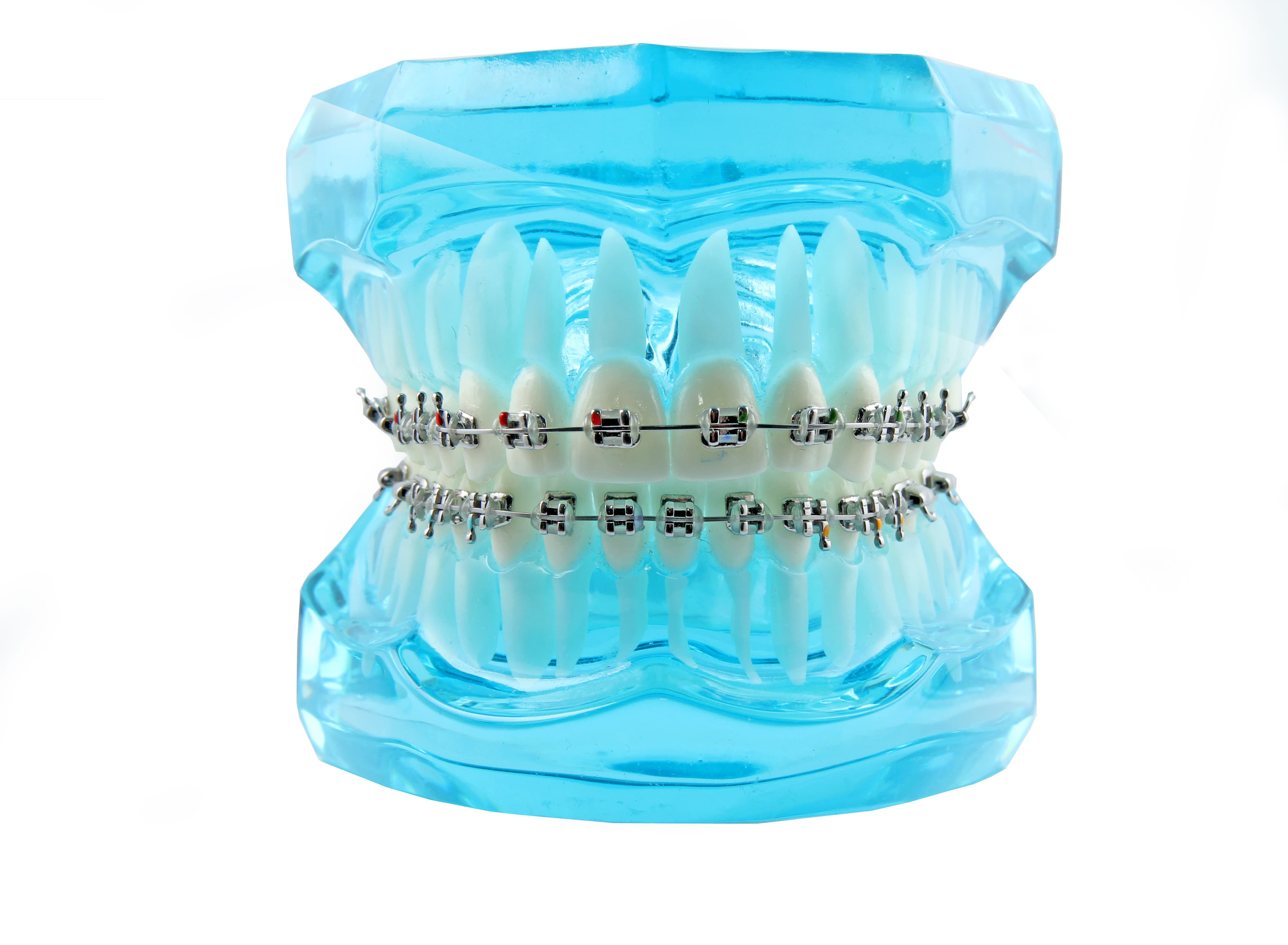 TIPODONTO BRACKETS METALICOS